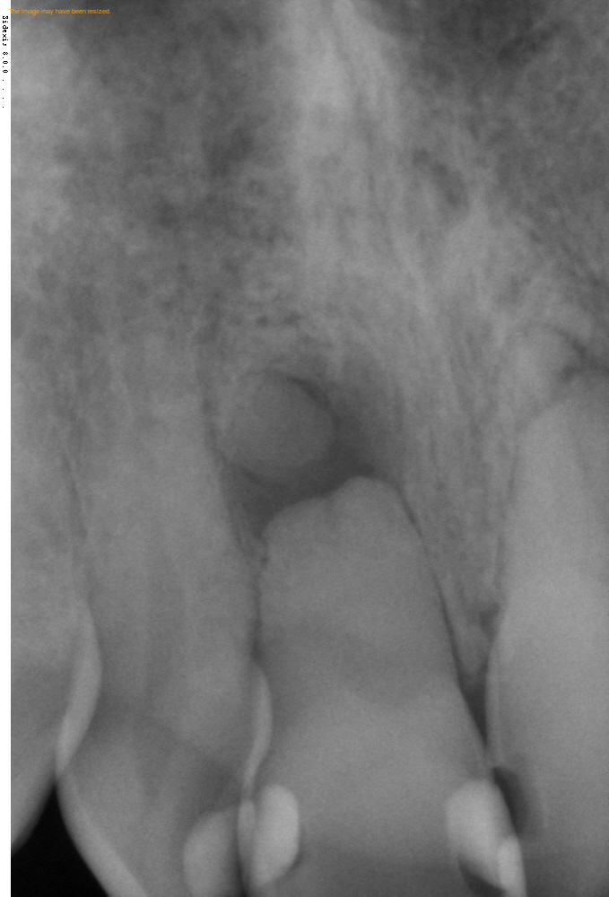 Featured image for “Calcified #11 and apical horizontal root fracture”